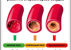 Плохой и хороший холестерин